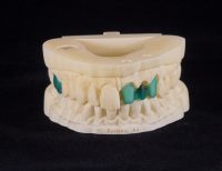 3-D printing, Full arch with Waxups